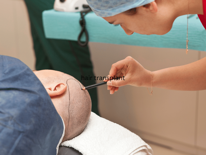 מה שונה בהשתלת שיער בטורקיה מהשתלת שיער בארץ?
